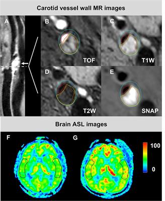 Associations Between Carotid Plaque Characteristics and Perioperative Cerebral Blood Flow Determined by Arterial Spin Labeling Imaging in Patients With Moderate-to-Severe Stenosis Undergoing Carotid Endarterectomy